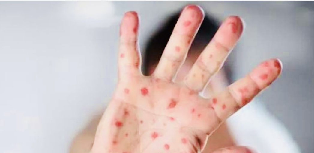 الصحة العالمية: عدد إصابات جدري القردة في أوروبا تضاعف ثلاث مرات